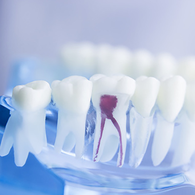 Endodontie (Wurzelbehandlung) | Zahnarzt Dr. Lempa Wolfenbüttel
