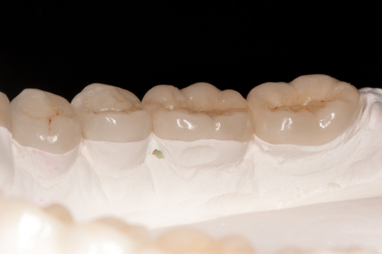 Bisshebung2 Zahnarzt Wolfenbüttel